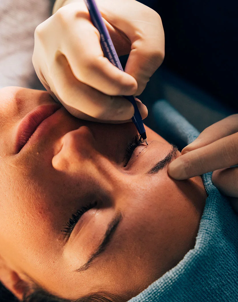 Close-up of a person's face during an eye procedure, with gloved hands holding a small, dark-purple instrument near the upper eyelid. The patient, with light tan skin, lies on a surface covered with a teal-blue cloth. Lighting is focused on the eye area, emphasizing the precision of the procedure. - Upper Blepharoplasty in Greenville, NC